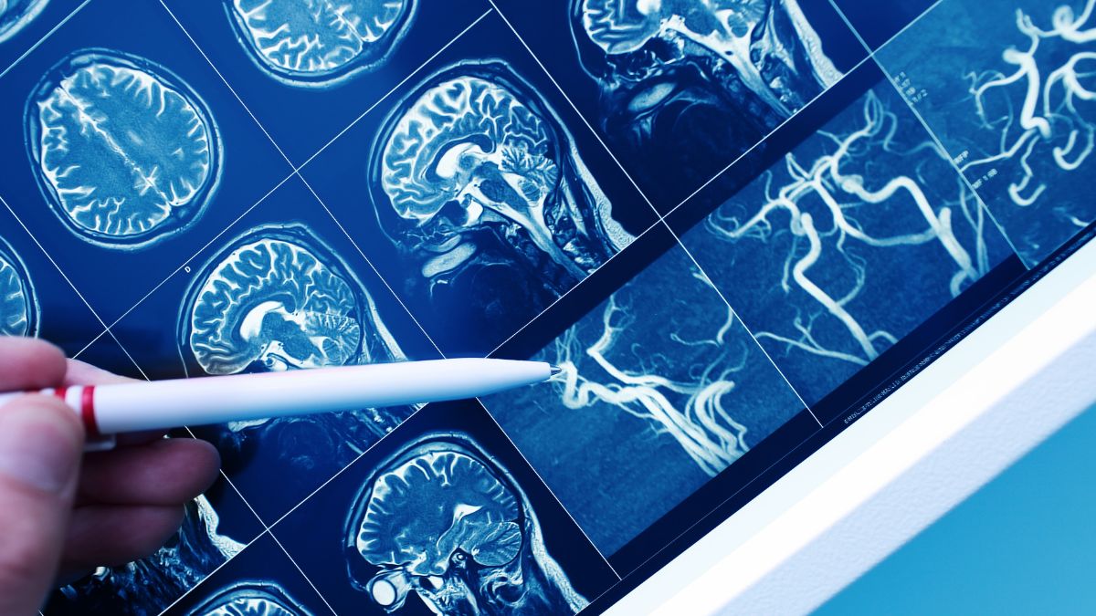 Częstość występowania i przeżycie pacjentów z przerzutami mięsaka do mózgu w materiale...