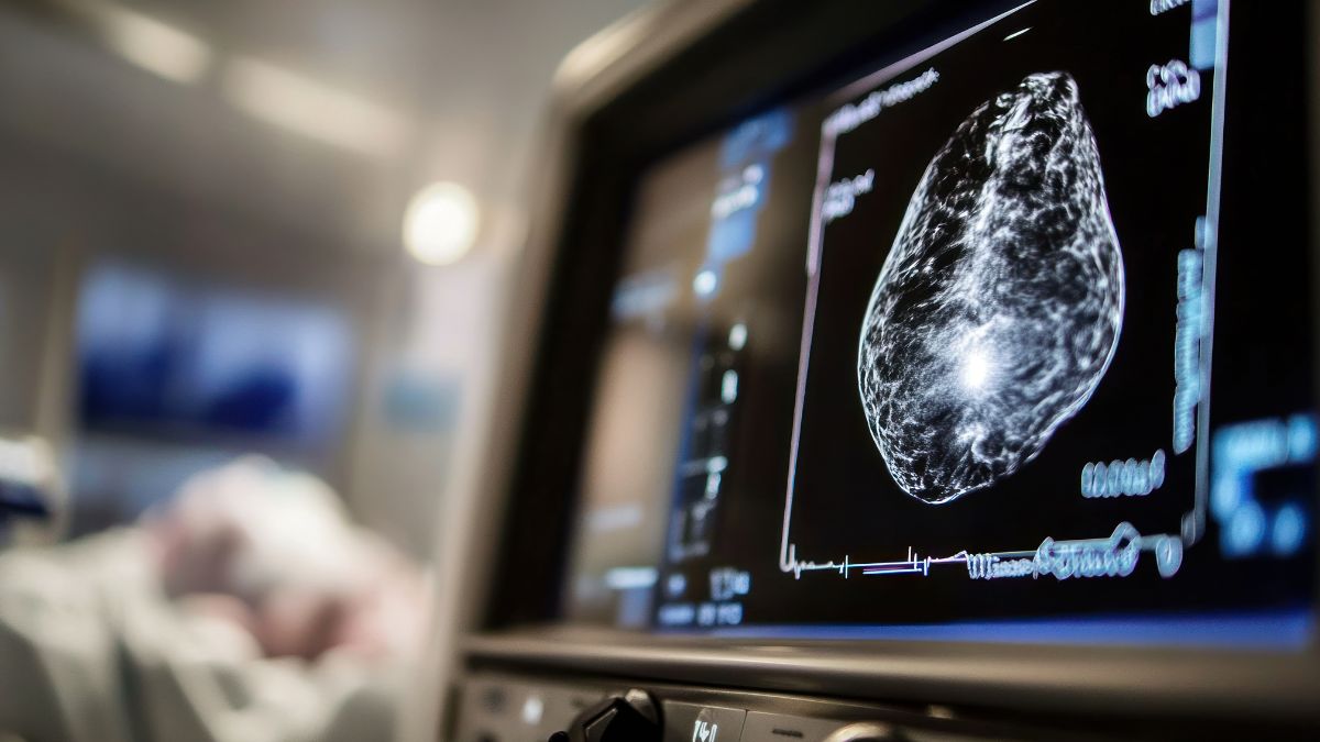 Residual cancer Burden (RCB) jako czynnik rokowniczy w raku zrazikowym piersi