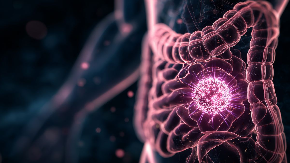 Tislelizumab z bewacyzumabem i chemioterapią XELOX w I linii leczenia raka jelita...