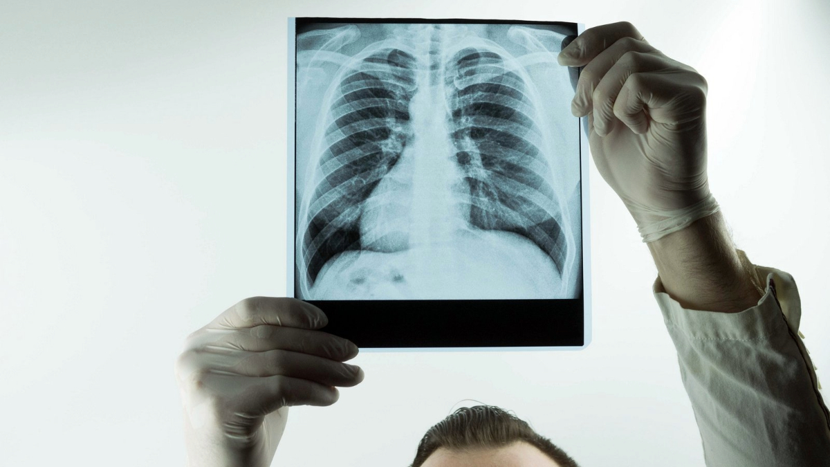 Pembrolizumab z chemioterapią w I linii leczenia przerzutowego NSCLC: po korekcie...