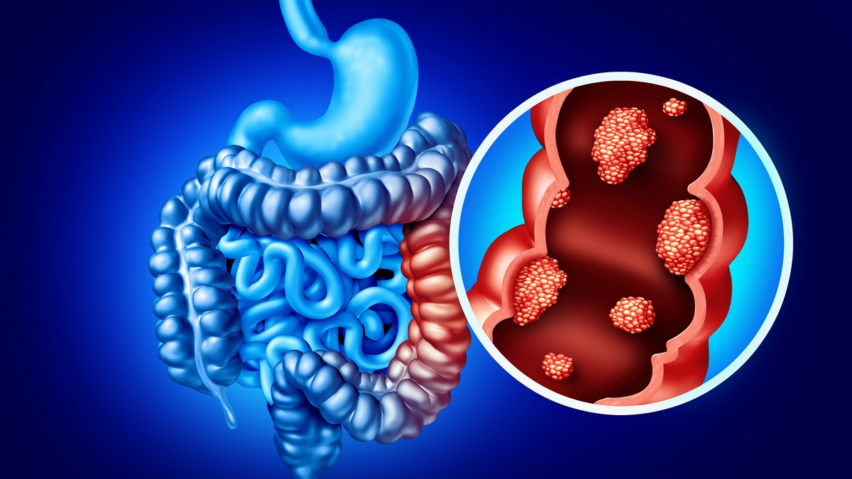 Zanzalintynib z atezolizumabem w porównaniu z regorafenibem – wyniki badania III...