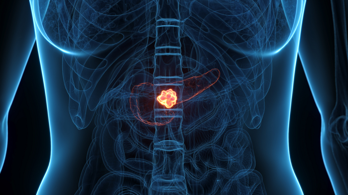 Nowości w leczeniu raka trzustki – RAS inhibitory